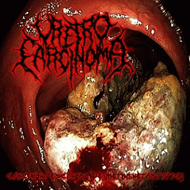 Uretrocarcinoma : Carcinoma Escamoso de Uretra Metastatico